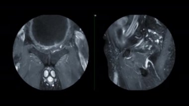MRI prostat bezini, koronal ve sagittal T1 yağ baskılarını karşılaştırın. Yaşlı erkeklerde prostat kanseri hücresi teşhisi için gadolinyum kontrastı..
