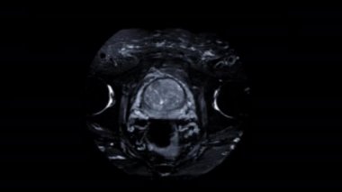Yaşlı erkeklerde prostat kanseri hücresi teşhisi için MRI prostat bezi.