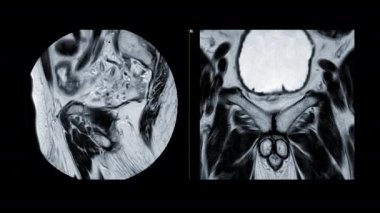 MRI prostat bezi Sagittal T2W Prostat kanseri hücresi teşhisi için yaşlı erkeklerde görüş.