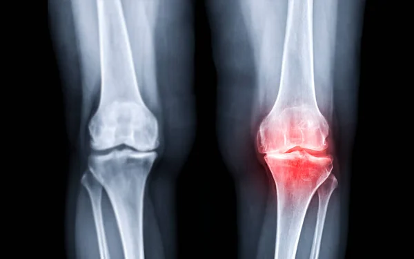 Focus Selettivo Dell Immagine Raggi Entrambi Vista Ginocchio Osteoartrite Diagnostica — Foto Stock