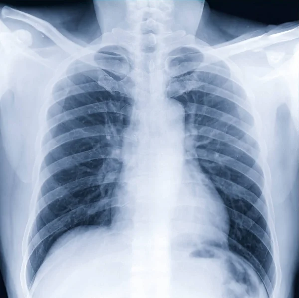 Chest Ray Ray Image Human Chest Medical Diagnosis Check Concept — Stock Photo, Image