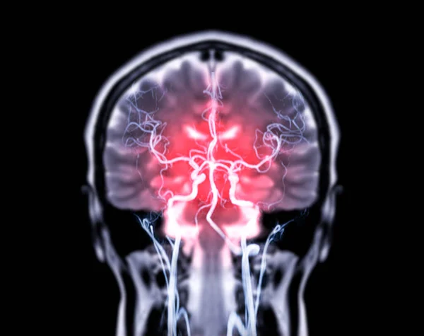 Mri Brain Coronal T2W Mra Brain Fusion Coronal View — Stock Photo, Image