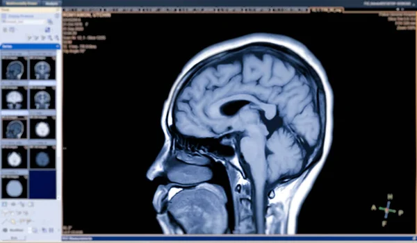 Mri Visão Sagital Cérebro Para Detectar Uma Variedade Condições Cérebro — Fotografia de Stock