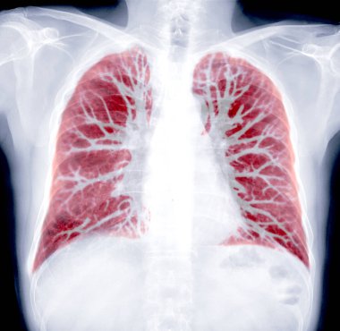 CT Chest Lung tespit edilen tüberküloz için ayarlandı