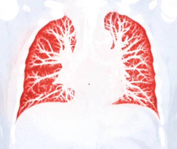 Chest Lung Preset Detected Tuberculosi — Stock Photo, Image