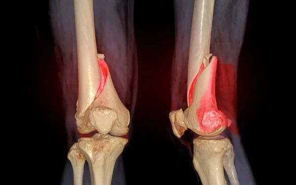 Diz Görüntüleme Lateral Görünüm Siyah Arkaplan Üzerinde Izole Uyluk Kemiği — Stok fotoğraf