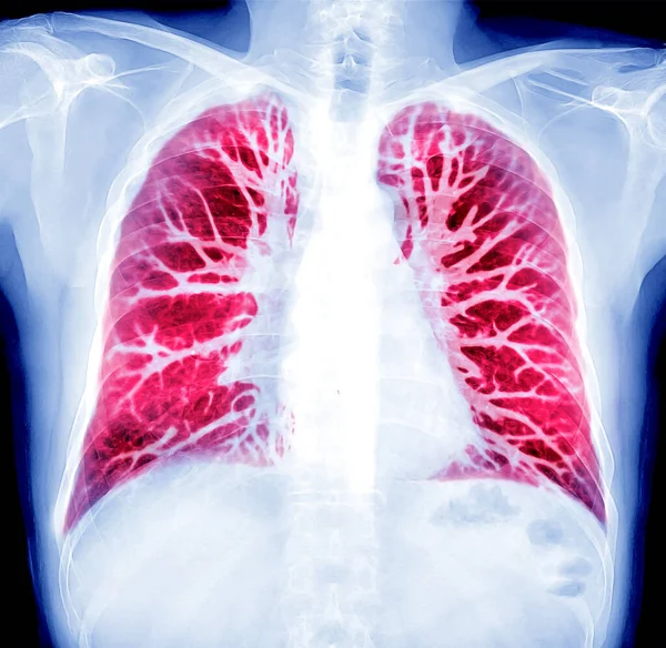 検出された結核のための胸部X線またはX線画像とCt胸部肺プリセットのオイルペイント効果 — ストック写真