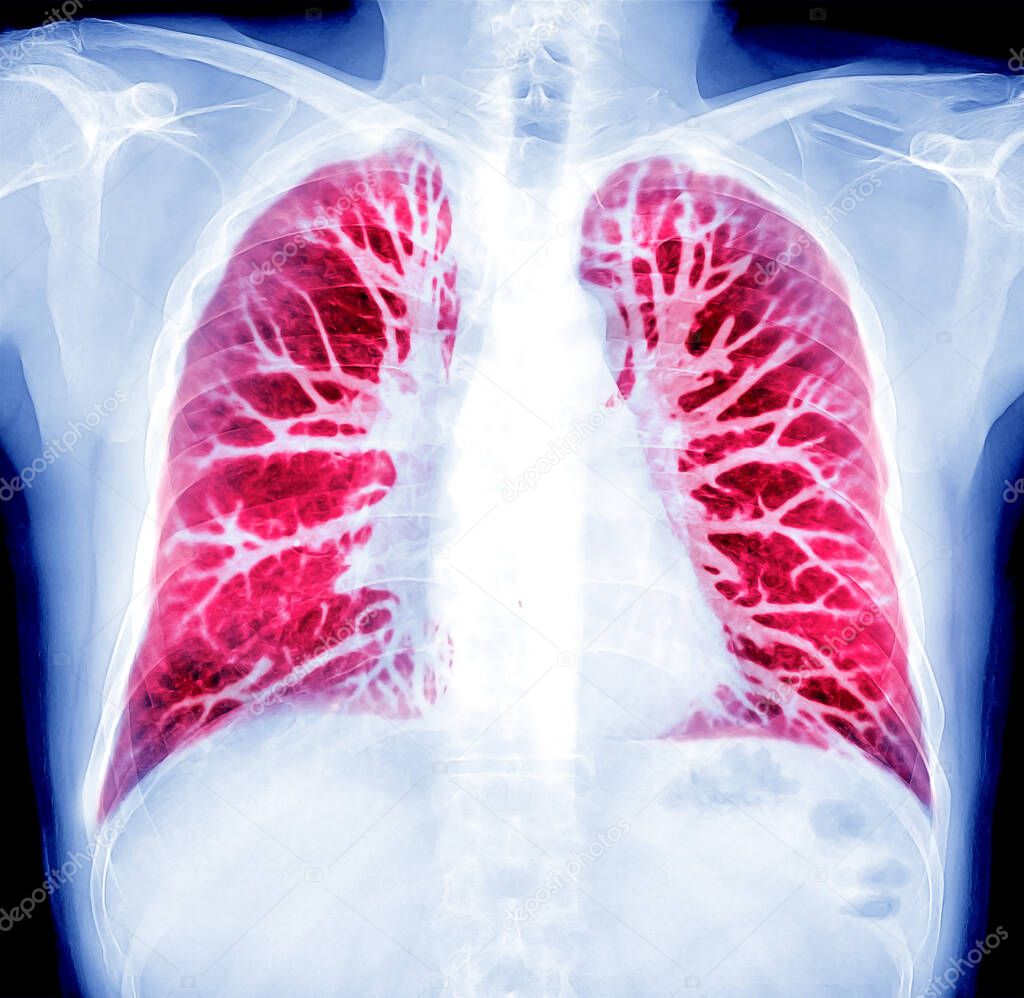 Oil paint effect  of Chest X-ray or X-Ray Image and CT Chest Lung preset for detected  tuberculosis