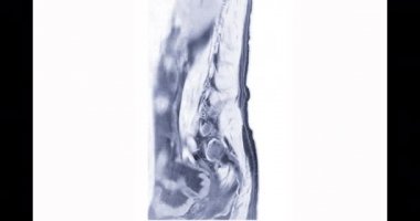 Sagittal düzlemde omurilik sıkışması için MRI L-S omurgası veya bel kemiği..