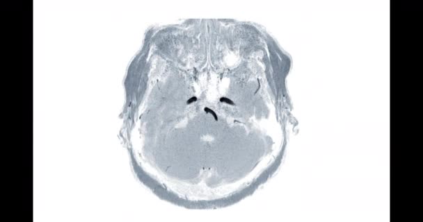 Mra Angiografía Cerebral Por Resonancia Magnética Del Cerebro Mip Axial — Vídeo de stock