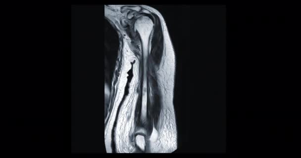 Braccio Omero Osseo Risonanza Magnetica Del Braccio Dell Omero Coronal — Video Stock