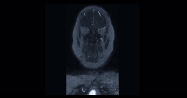 Kontrast Mra Brain Oder Magnetresonanzangiographie Des Gehirns Koronale Mip Ansicht — Stockvideo