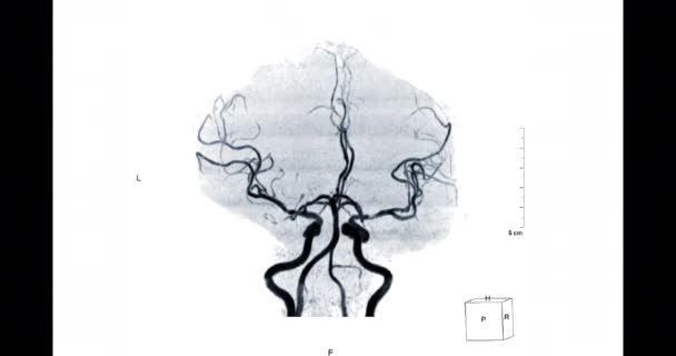 Mra Angiografía Cerebral Por Resonancia Magnética Del Cerebro Mip Tof — Vídeo de stock