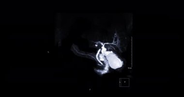 MRCP ya da Manyetik rezonans kolanjiyokreatografi 3 boyutlu MIP görüntüsü safra yolu ve pankreas kanallarını görselleştirmeyi gösteriyor .