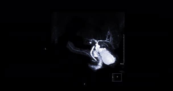 Mrcp Magnetic Resonance Cholangiopancreatography Mip View Showing Visualize Biliary Tract — 图库视频影像