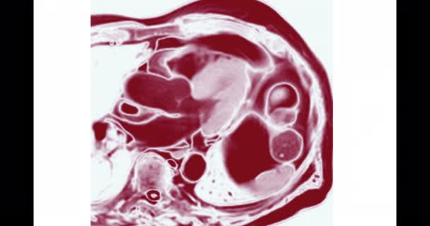 心臓のMri心臓のMri 磁気共鳴画像法 心臓疾患を検出するための心臓の鼓動を示す — ストック動画