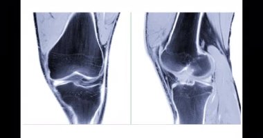 Diz eklemi eklemlerinin MRI veya manyetik rezonans görüntüleriyle karşılaştırıldığında, teşhis için beyaz zemin üzerinde, Anterior çapraz bağ yırtılması (ACL) yırtılması.