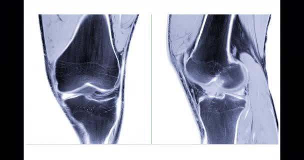 Comparación Rodilla Resonancia Magnética Articulación Rodilla Vista Coronal Sagital Sobre — Vídeos de Stock