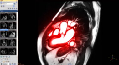 Kalp MR 'ı veya kalp MR' ı Sagittal görüşünde kalbin manyetik rezonans görüntülemesi sol ve sağ ventrikülün bulanık monitörde kalp hastalığını tespit etmek için çapraz kesitlerini gösteriyor.