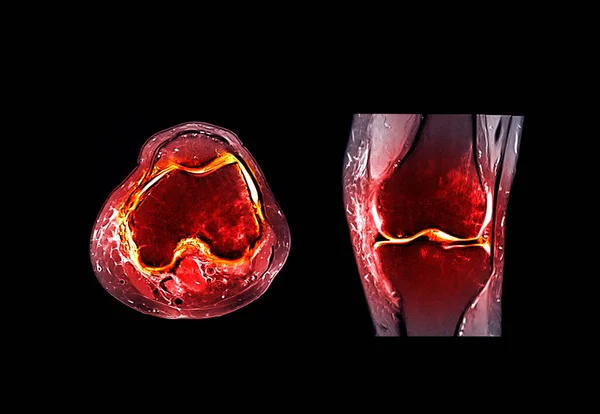 前十字靭帯の裂傷または捻挫を検出するための磁気共鳴画像法またはMri膝関節の比較コロナおよびサージタルビュー Acl — ストック写真