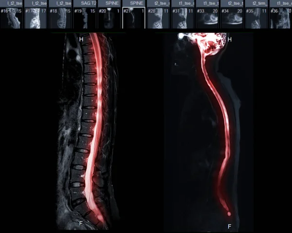 Toda Coluna Vertebral Plano Sagital T2W Para Diagnóstico Compressão Medular — Fotografia de Stock