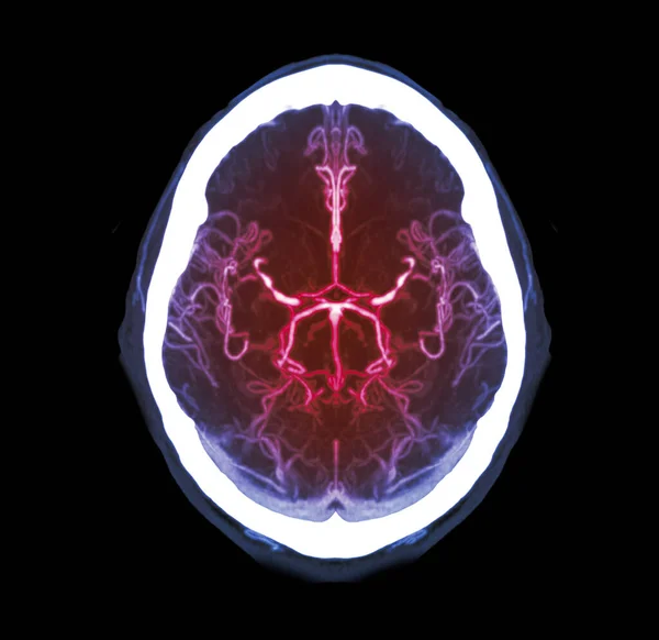 Verzameling Van Cta Hersenen Angiografie Van Hersenvergelijking Mip Techniek Axiale — Stockfoto