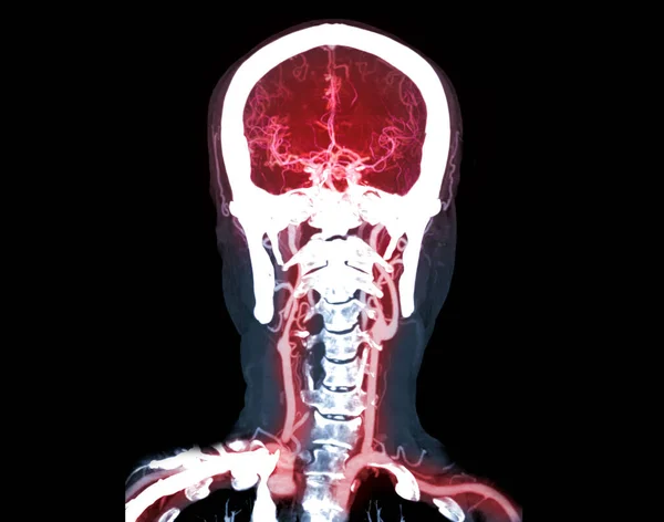 Raccolta Del Cervello Cta Angiografia Del Confronto Cerebrale Tecnica Mip — Foto Stock