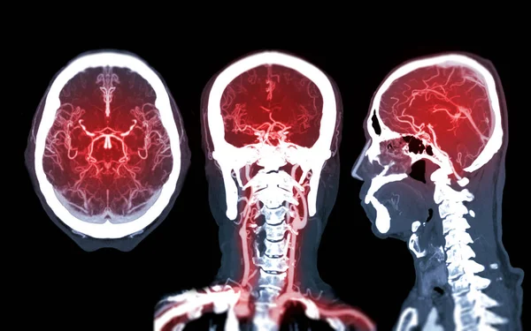 Raccolta Angiografia Cerebrale Cta Del Confronto Cerebrale Tecnica Mip Vista — Foto Stock