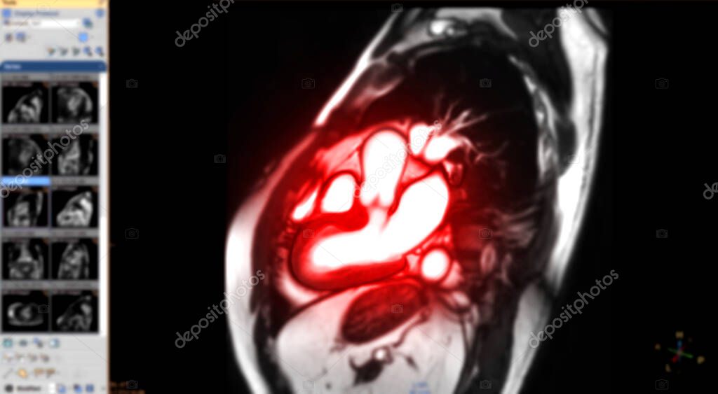 MRI heart or Cardiac MRI resonance imaging of heart in