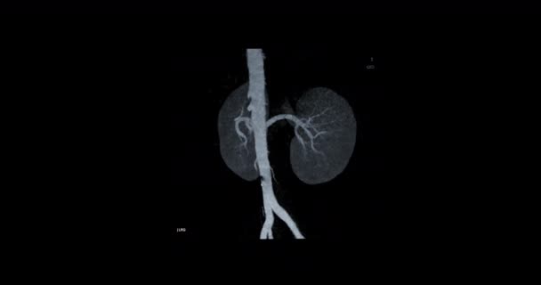 Cta Abdominal Cta Adtery Renal Técnica Mip Girando Tela Mostrando — Vídeo de Stock