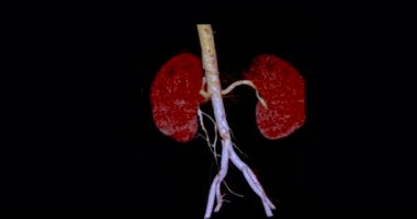 CTA Abdominal veya CTA renal adarter 3D görüntüleme her iki böbreği de gösteren ekranda dönüyor.