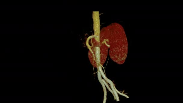 Cta Abdominal Cta Adtery Renal Imagem Renderização Girando Tela Mostrando — Vídeo de Stock