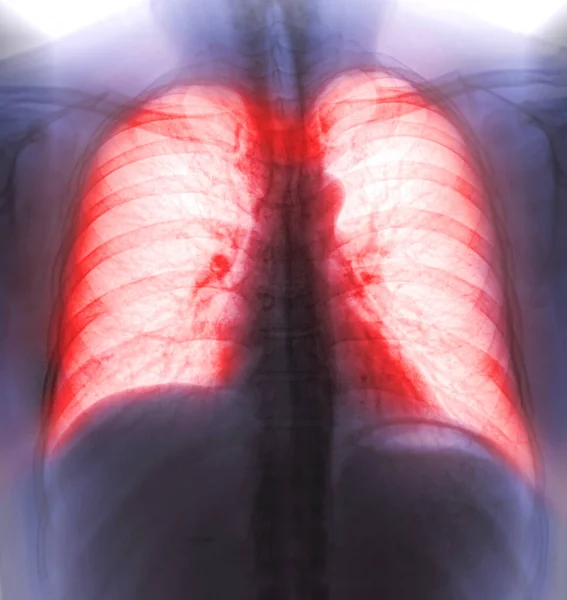 Chest X-ray or X-Ray Image Of Human Chest or Lung ( red zone ) showing tuberculosis