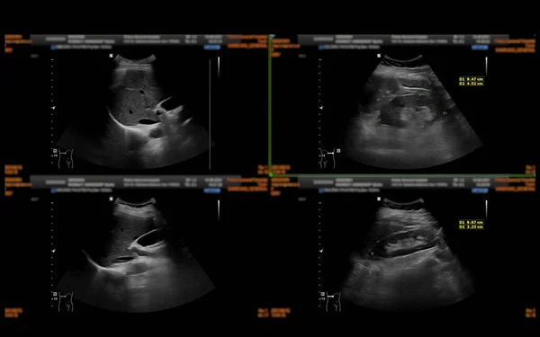 超声上腹部显示肝脏 胆囊及肾脏检查腹部疾病 — 图库照片