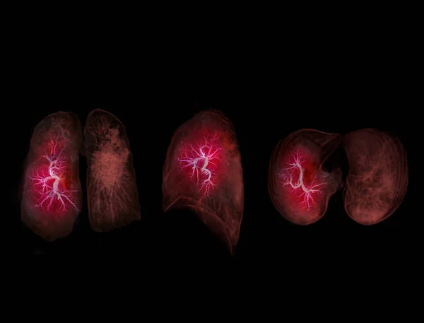 Foco Seletivo Imagem Tórax Pulmão Para Diagnóstico Doenças Pulmonares Tuberculose — Fotografia de Stock