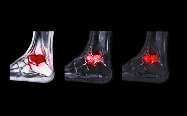 足首関節損傷の診断腱のためのMri足首関節の仙骨ビューの比較 — ストック写真
