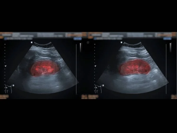 신장을 위쪽에 초음파로 보이는 신장병 검사용 — 스톡 사진