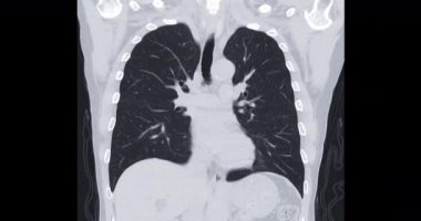 TB, tüberküloz ve koronavirüs veya covid-19 teşhisi için akciğer koronal MIP taraması .