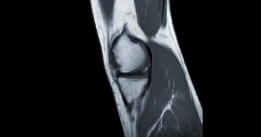 Anterior çapraz bağ yırtılması (ACL) teşhisi için diz eklemi sagittal PDW 'nin MRI veya manyetik rezonans görüntülemesi