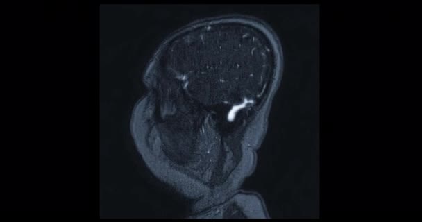 Mra Hersenen Magnetische Resonantie Angiografie Van Cerebrale Slagader Hersenen Sagittale — Stockvideo