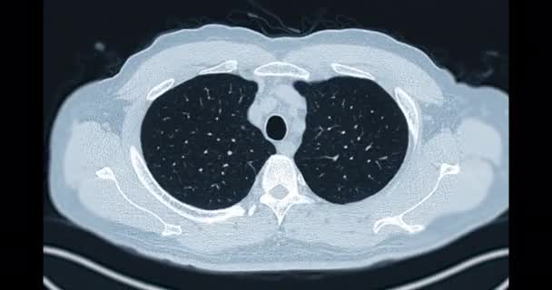 Torace Scansione Del Mip Assiale Polmonare Vista Diagnosi Tubercolosi Coronavirus — Video Stock