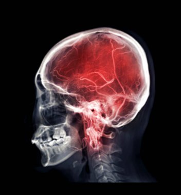 Mix skull image and  MRV Brain or magnetic resonance venography of The Brain for abnormalities in venous drainage of the brain  clipart