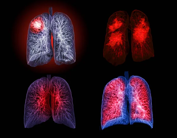 Raccolta Immagine Rendering Chest Lung Sul Monitor Diagnosi Tubercolosi Covid — Foto Stock