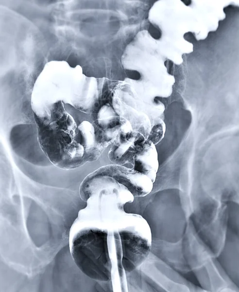 钡灌肠显示L直肠和结肠诊断大肠癌或结肠癌 — 图库照片