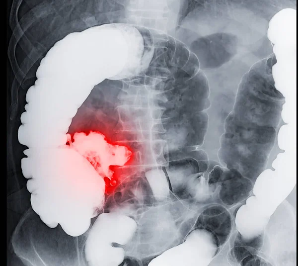 Enema Bario Demostró Ciego Colon Para Diagnóstico Cáncer Colorrectal Cáncer — Foto de Stock