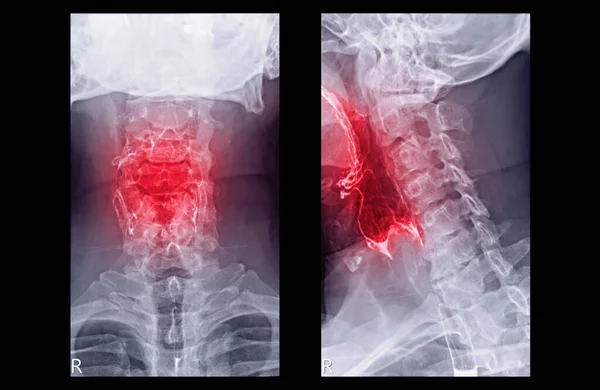 Esophagram Barium Swallow Lateral View Showing Esophagus Diagnosis Gerd Gastroesophageal — Stock Photo, Image