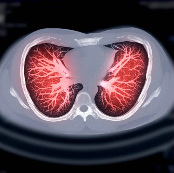 Tórax Axial Mip View Para Diagnóstico Câncer Pulmão Tuberculose Covid — Fotografia de Stock