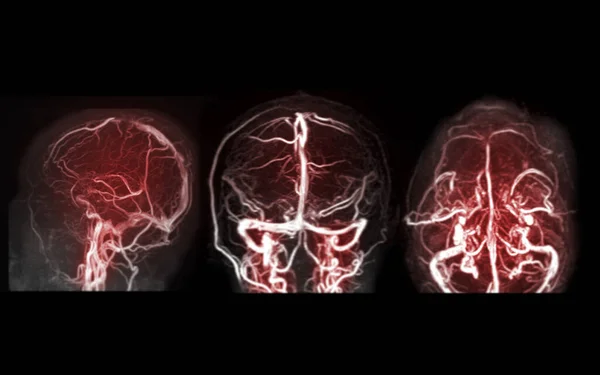 Mrv Cervello Risonanza Magnetica Venografia Del Cervello Anomalie Nel Drenaggio — Foto Stock
