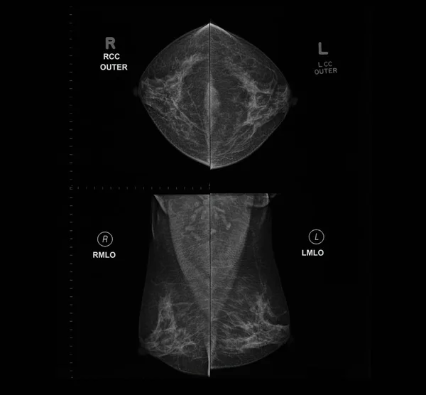 Rentgen Digitální Mamogram Nebo Mamografie Obou Stranách Prsu View Mlo — Stock fotografie