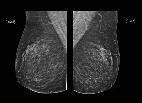 디지털 Ray Digital Mammogram Mammography 여성에게 유방암의 대각선을 방법이다 — 스톡 사진
